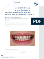 Full Mouth Adhesive Rehabilitation of A Severely Eroded Dentition