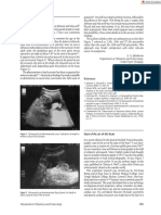 Ultrasound in Obstet Gyne - 2002 - Jakobovits - Fetal Penile Erection