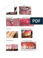 Carcinoma Epidemoide Mucocele