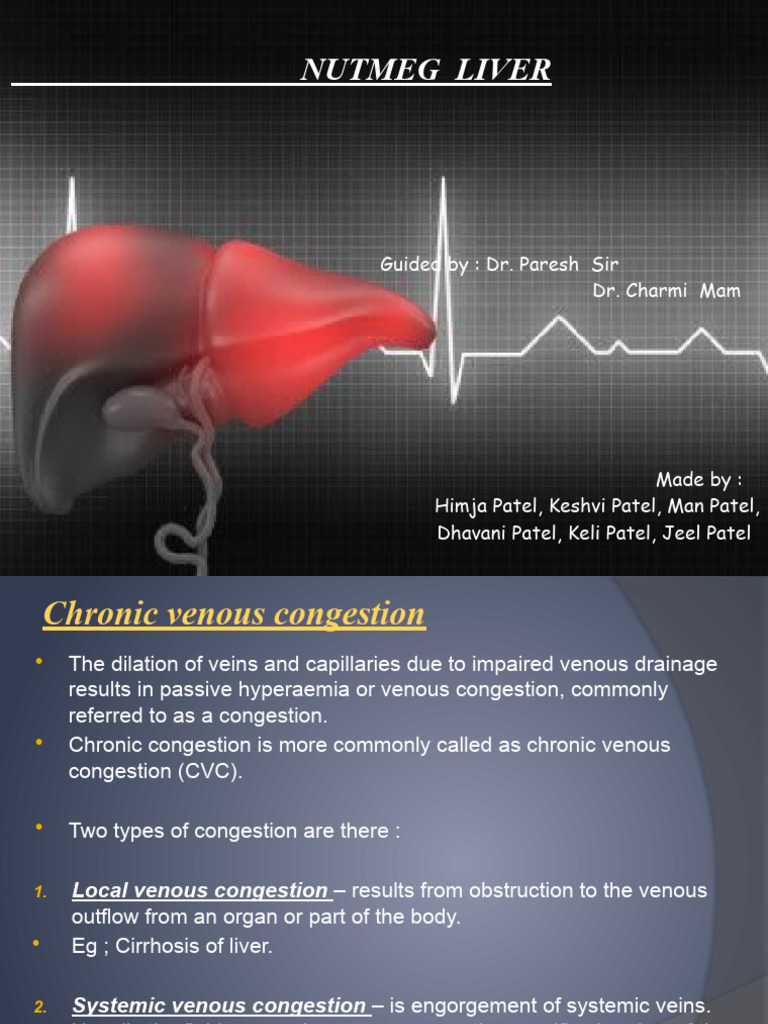 Nutmeg Liver PDF Liver Vein
