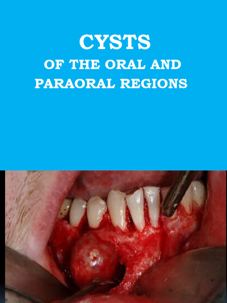Oral and Paraoral Cysts Overview | PDF