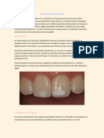 Caries en Esmalte Dental