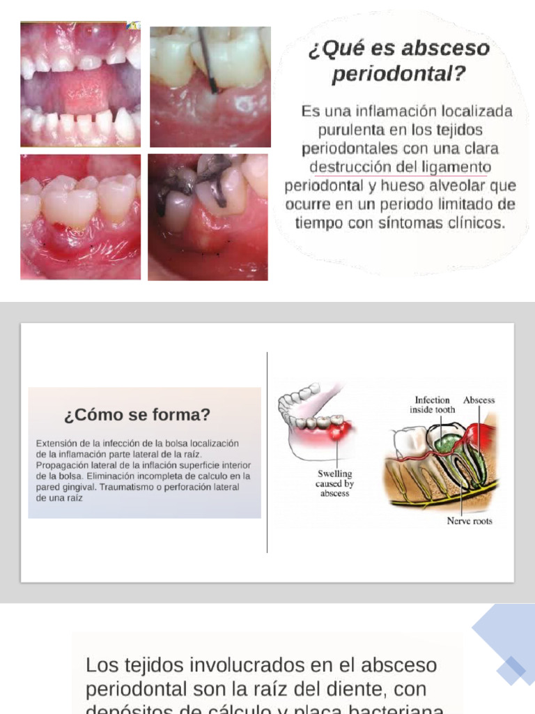 Abscesos Periodontales Expo | PDF | Ciencias de la Salud | Epidemiología
