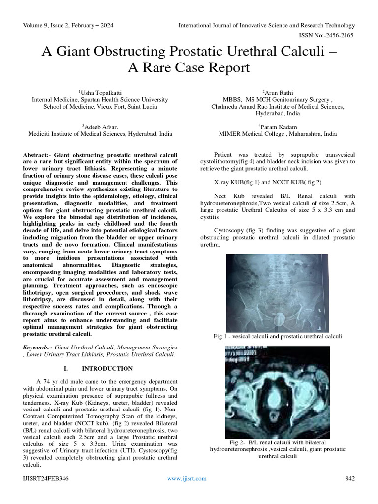A Giant Obstructing Prostatic Urethral Calculi A Rare Case Report