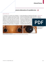 Bilateral Spontaneous Anterior Dislocation of Crystalline Lens