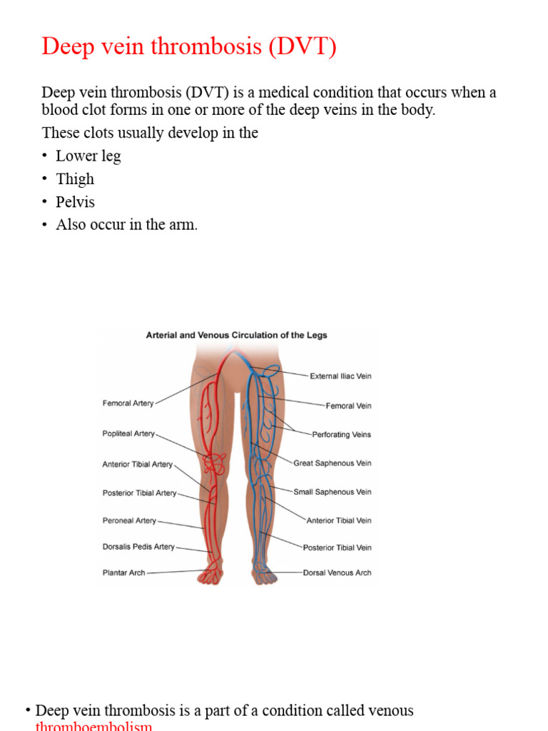 Dvt Prevention Crucial After Your Icd Procedure - ou4q863