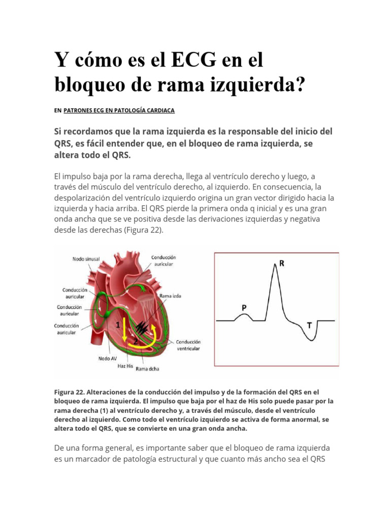y-c-mo-es-el-ecg-en-el-bloqueo-de-rama-izquierda-pdf