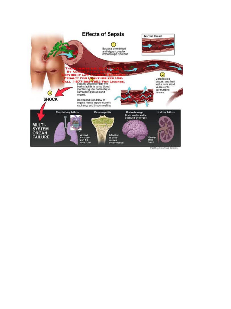 Gambar Sepsis | PDF