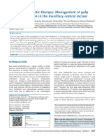 Guided Endodontic Therapy Management of Pulp Canal Obliteration