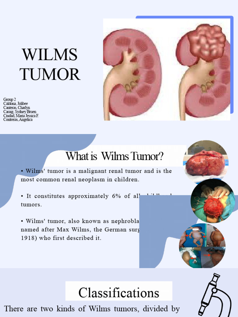 Wils Tumor Pdf Cancer Radiation Therapy