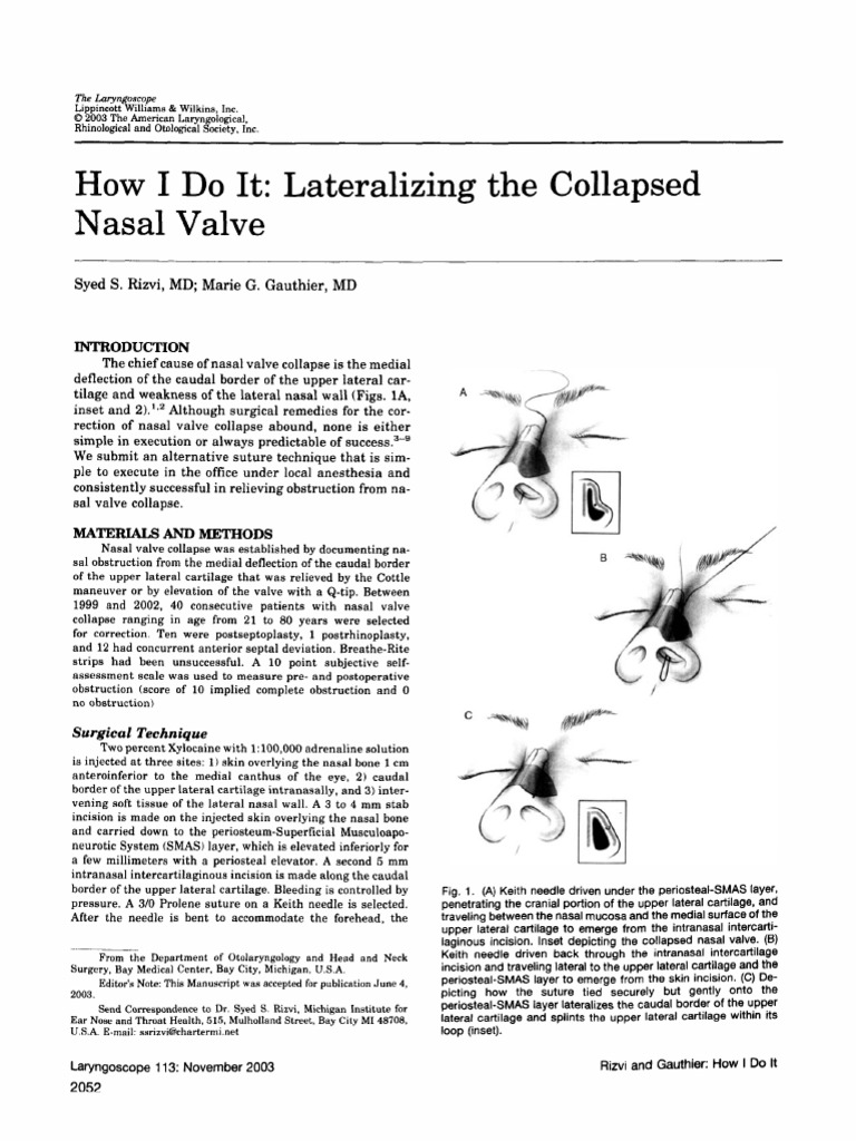 The Laryngoscope 2010 Rizvi How I Do It Lateralizing The