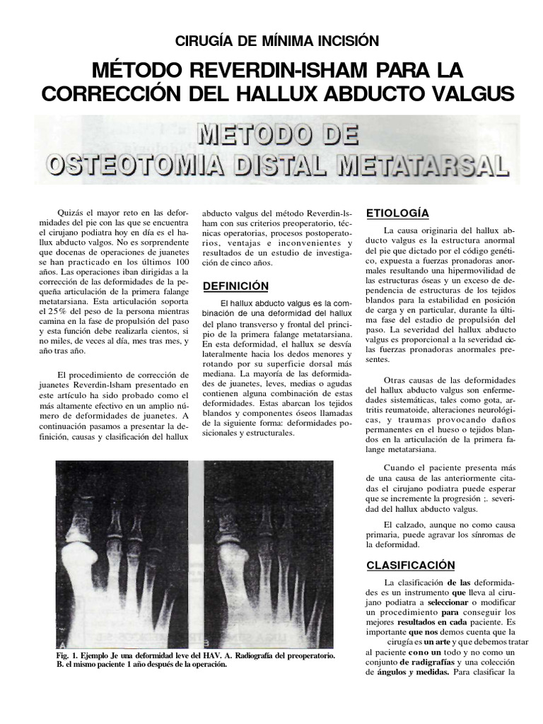 Método Reverdin-Isham en Hallux Valgus | PDF | Dedo del pie | Anatomía ...