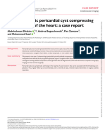 A Hemorrhagic Pericardial Cyst Compressing The Rig