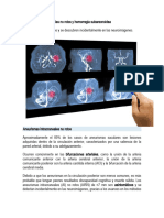 Aneurismas Intracraneales No Rotos y Hemorragia Subaracnoidea