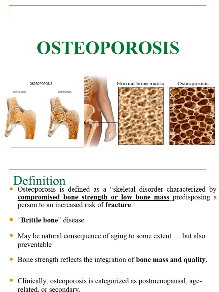 Osteoporosis | PDF | Bone | Osteoporosis