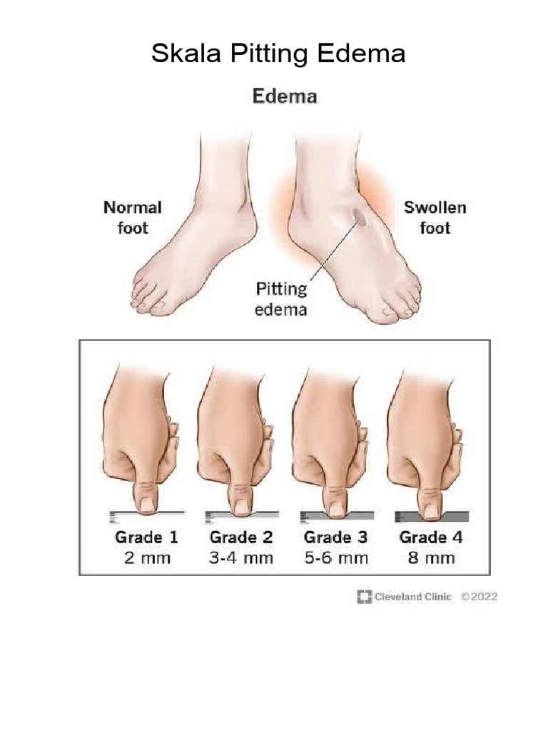 Skala Pitting Edema | PDF