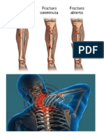 FRACTURA