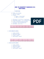 Quick Guide To Identify Various Ecg Rhythms