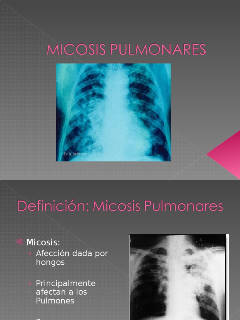 Micosis Pulmonar: Diagnóstico y Tratamiento | PDF | Tos | Meningitis