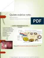 Dolor Pelvico Agudo Quiste Roto-170604193359