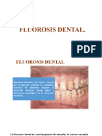 Fluorosis Dental