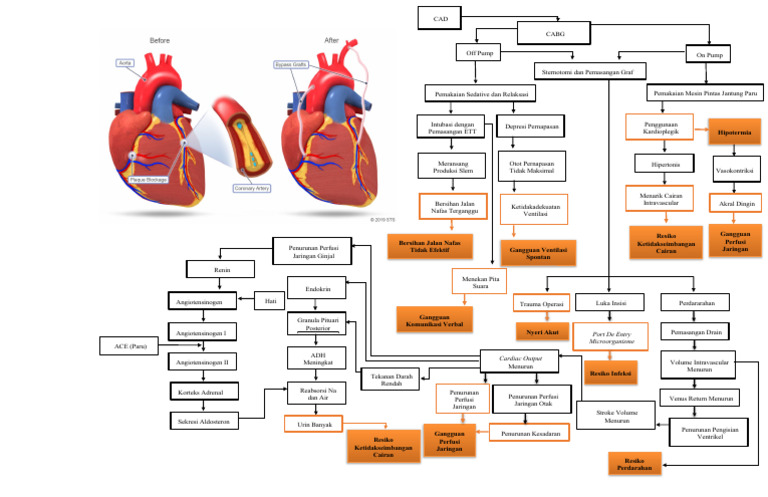 Penanganan CAD dalam CABG Off Pump | PDF