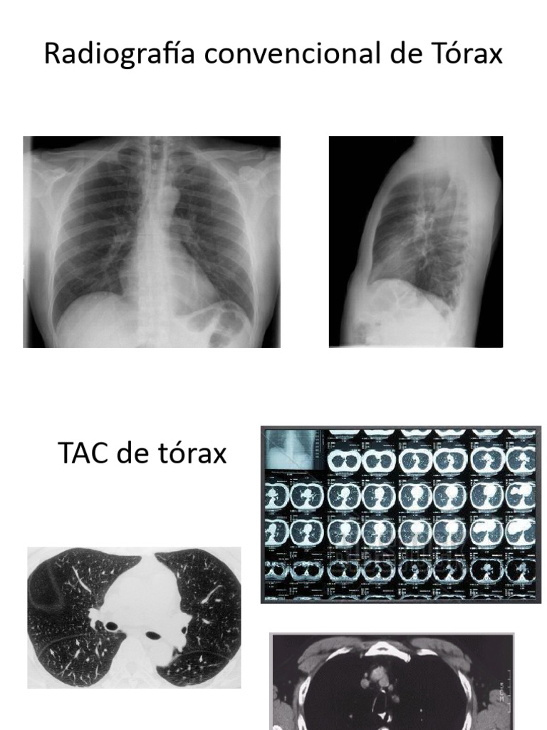 Exploración Radiológica del Tórax | PDF | Aorta | Pulmón