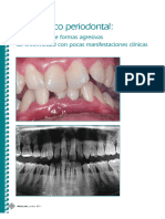 Diagnóstico Periodontal Presentación de Formas Agresivas de Enfermedad Con Pocas Manifestaciones Clínicas