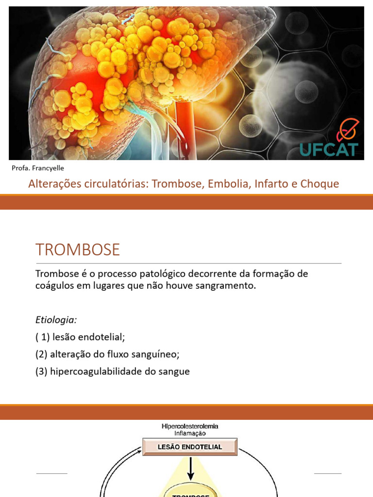 Trombose, Embolia e Infarto: Patologias Circulatórias | PDF | Embolia ...