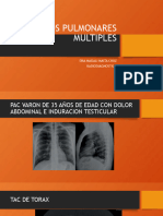 Nodulos Pulmonares Multiples