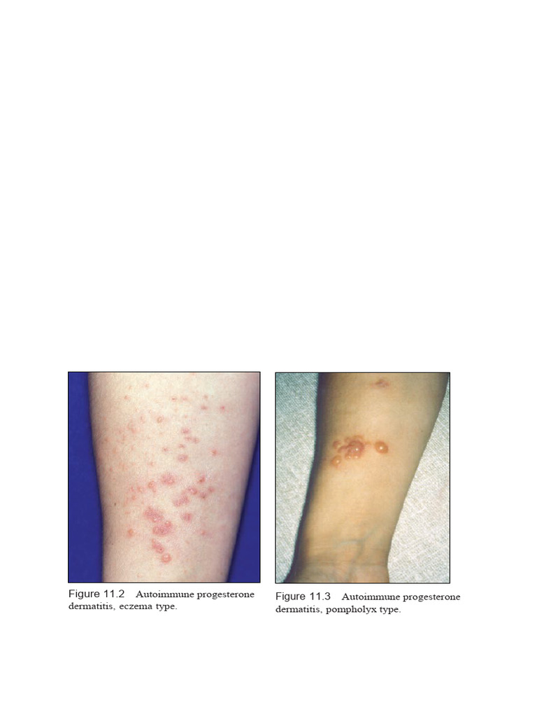 Is Your Diet Worsening Your Autoimmune Progesterone Dermatitis - 3n4jgrh