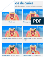 Grados de Caries