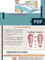 Placenta Previa Exponer