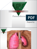 z16 Pneumothorax Hemothorax