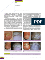 Hiperquersatosis Subungueal