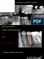 13 Interpretación de La Lesión Cariosa 15