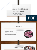 Hallazgos Radiológicos de Tuberculosis