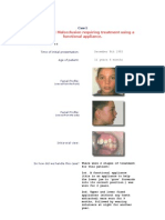 Class II Div 1 Malocclusion