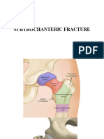 Subtrochanteric Fracture