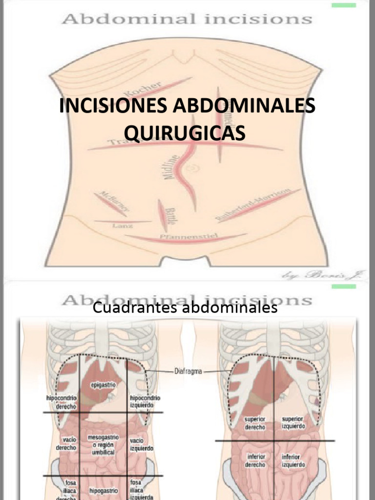 Tipos de Incisiones Abdominales Quirúrgicas | PDF | Abdomen | Cirugía