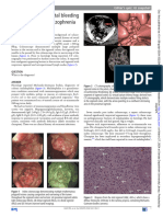 Unusual Cause of Rectal Bleeding in A Patient With Schizophrenia