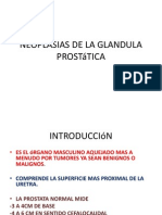 Neoplasias de La Glandula Pro Static A