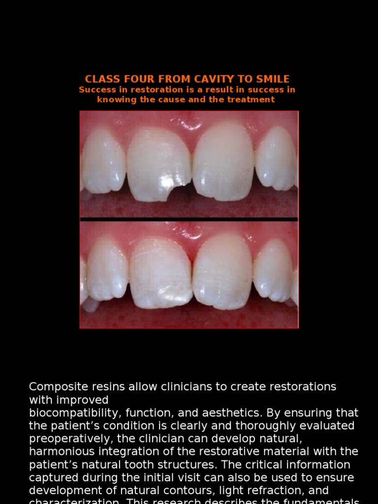 ClassIV Final | PDF | Dental Composite | Tooth Enamel