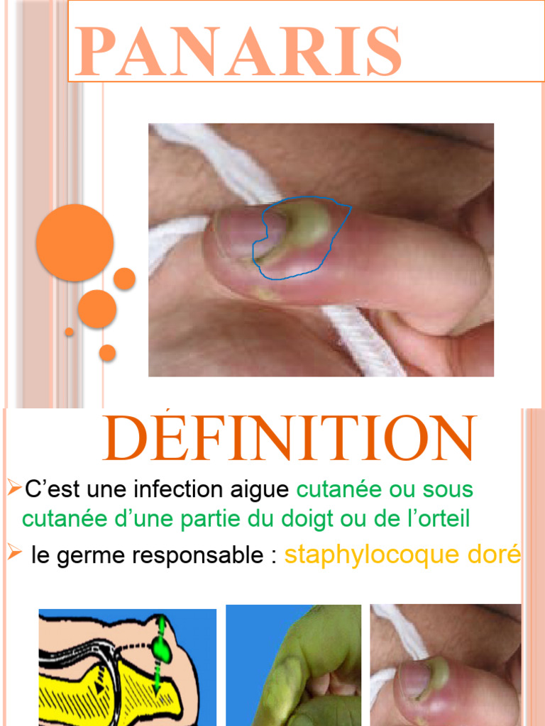 Panaris : Causes et Traitements Stade 2 | PDF