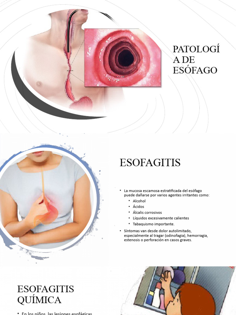 Tipos y Morfología de Esofagitis | PDF | Infección | Virus