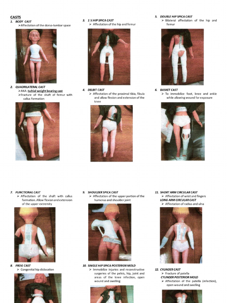 CASTS - Orthopedic Rotation (Philippine Orthopedic Center) | PDF