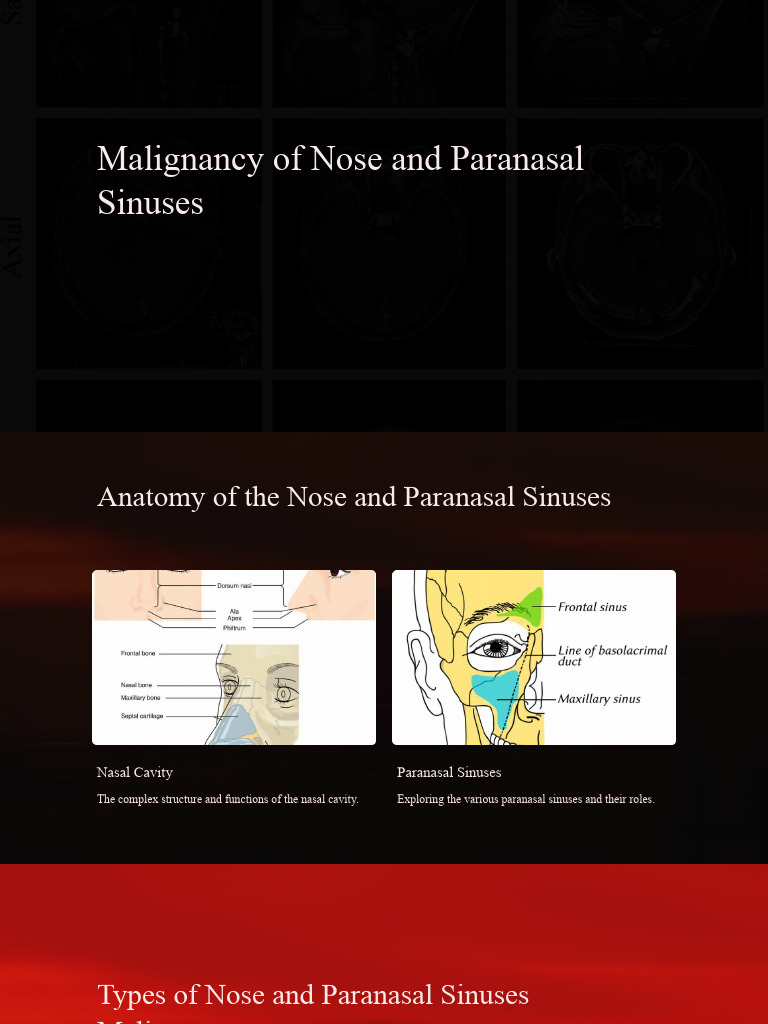 Malignancy of Nose and Paranasal Sinuses | PDF | Cancer | Human Nose