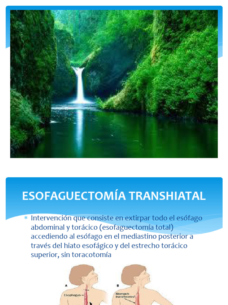 Técnicas de Esofaguectomía Transhiatal | PDF | Estómago | Abdomen