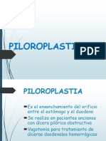 Piloroplastia