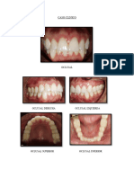 Caso Clinico Incrustación.